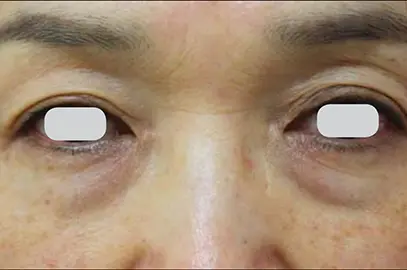лазерное удаление новообразований на коже лица - после процедуры