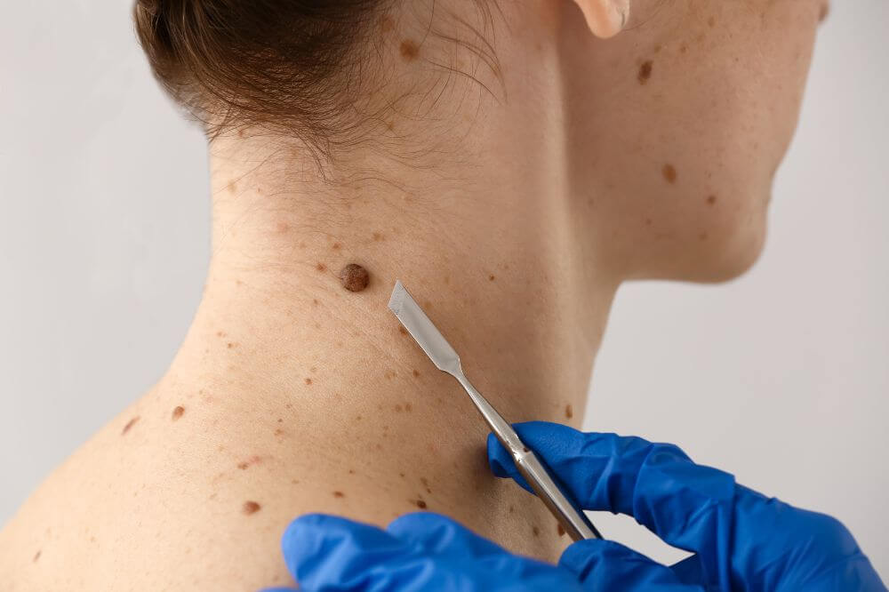 Как отличить возврат родинки от нового образования