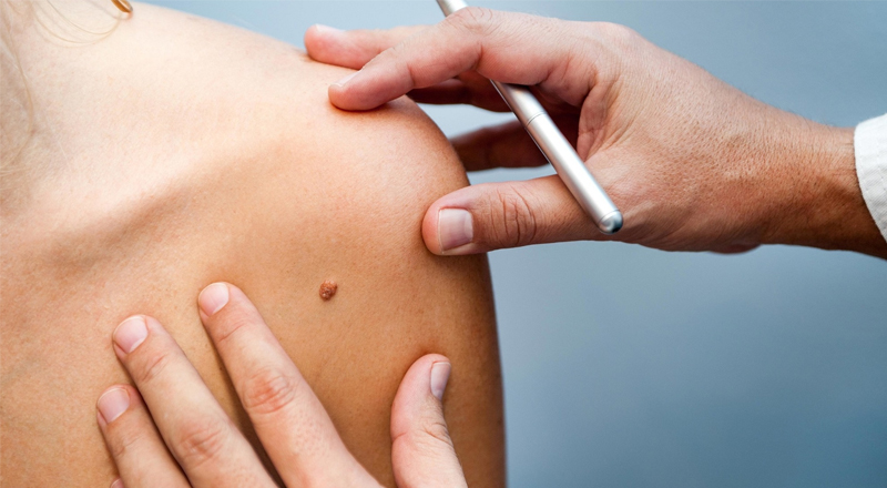 Как предотвратить появление родинки